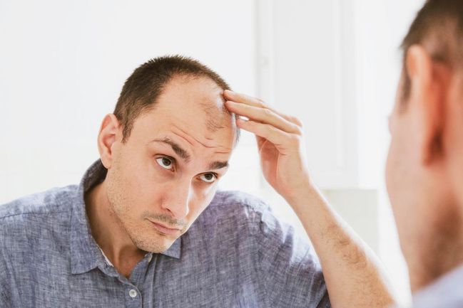 Kolika procent mužů se ztráta vlasů týká?