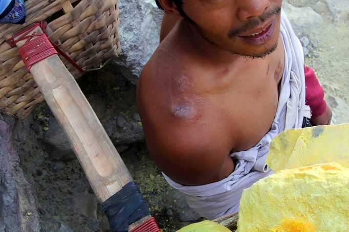 Sulfur miners risk health on Mount Ijen Jakarta, Indonesia. 24th October 2012 -- Shoulders of a miner injured by lifting sulfur baskets weighing as much as 75 kilograms at Mt. Kawah Ijen. -- On Mount Ijen in East Java sulfur mining activities were reopened in June 2012 after being closed because of renewed volcanic activity, but the mining is still not permitted in the crater because of potentially toxic gases being released.