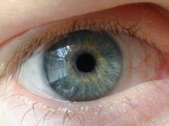 Nové technologie (wavefront) dokáží dokonce "spravit" oko tak, že bývalý pacient vidí dokonce lépe, než lidé, kteří brýle nikdy nepotřebovali.