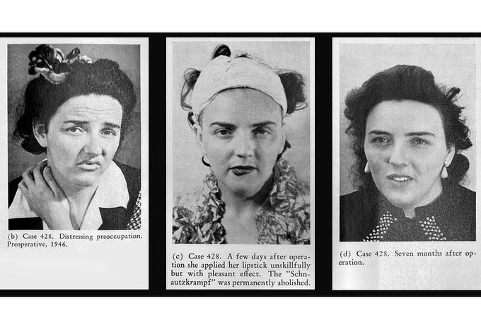 Portréty pacientky (případ 428) před lobotomií v roce 1946 a po ní. Fotografie dokumentují změny ve výrazu tváře po chirurgickém zákroku.