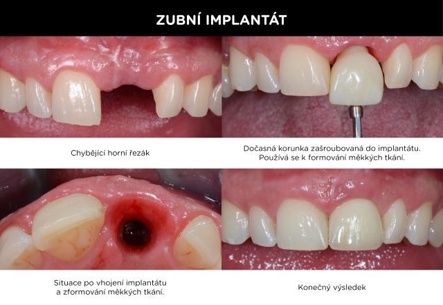 Ukázka nasazení implantátu