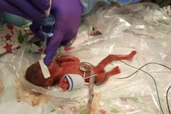 Nejmenší miminko na světě vážilo 250 gramů. Lékaře překvapilo, že dítě přežilo