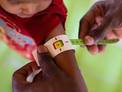 Lékař měří podvýživu maliského chlapce pomocí pásku MUAC (Mid-Upper Arm Circumference). Žlutá barva značí, že dítě je bezprostředně ohroženo podvýživou.