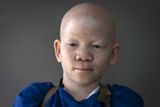 Dvanáctiletému Mwigulu Matonage z Tanzanie od narození chybí pigment v kůži, ve vlasech a v očích. Kromě šikany a izolace musel během svého života čelit i několika násilným útokům.