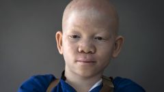 Albinismus v Tanzánii