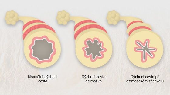 Astmatiků jsou v Česku statisíce. Třetina potíže zlehčuje