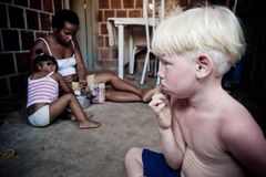 Tanzanie zatýká šamany. Zabíjejí albíny kvůli lektvarům