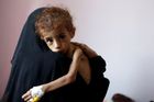 Během války v Jemenu už zemřelo hlady 85 tisíc malých dětí, ukazují odhady
