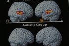 Jak léčit autismus? V dekompresní komoře
