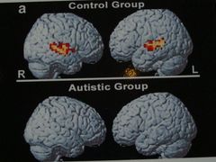 Obraz běžného mozku (nahoře) a mozku dítěte trpícího autismem (poruchou kontaktu s okolním světem) při reakci na lidský hlas - zdravému člověku mozek podnět registruje, což přístroj zobrazuje barevně, autistický mozek nijak nereaguje.