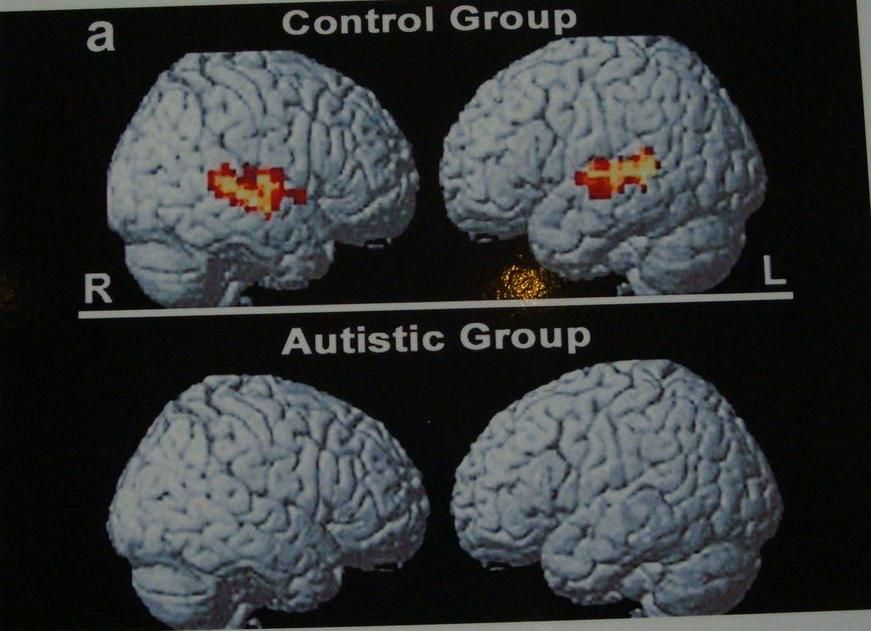 Autismus - mozek