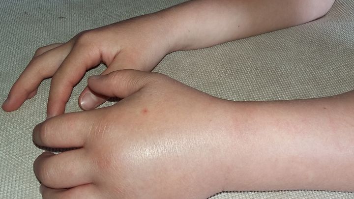 Otékají a dusí se. Nevyléčitelná nemoc ohrožuje život dětí, podobá se běžné alergii