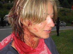 Romanu Krátkou policista udeřil tak silně, až jí žebro prorazilo plíci a způsobilo pneumotorax.