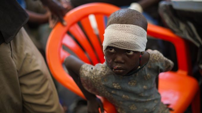 Lékaři bez hranic v táboře vysídlenců léčí také tuto dívku, která na kliniku přišla s popáleninami na hlavě.