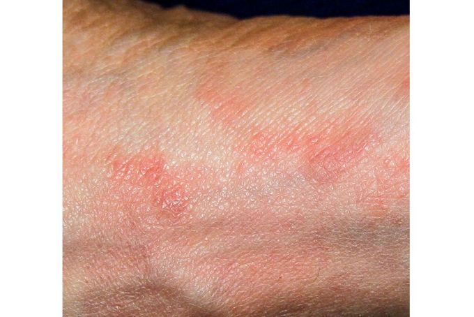 Svědivá vyrážka na zápěstí způsobená svrabem. Ilustrační snímek