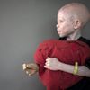Albinismus v Tanzánii