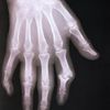 Artritida, zánětlivé onemocnění kloubů