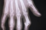 Rentgenový snímek ukazuje kosti v ruce stižené artritidou. Jde o revmatické onemocnění kloubů.