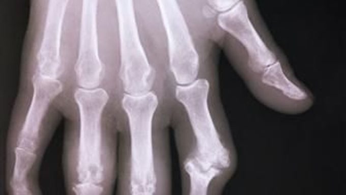 Rentgenový snímek ukazuje kosti v ruce stižené artritidou. Jde o revmatické onemocnění kloubů.