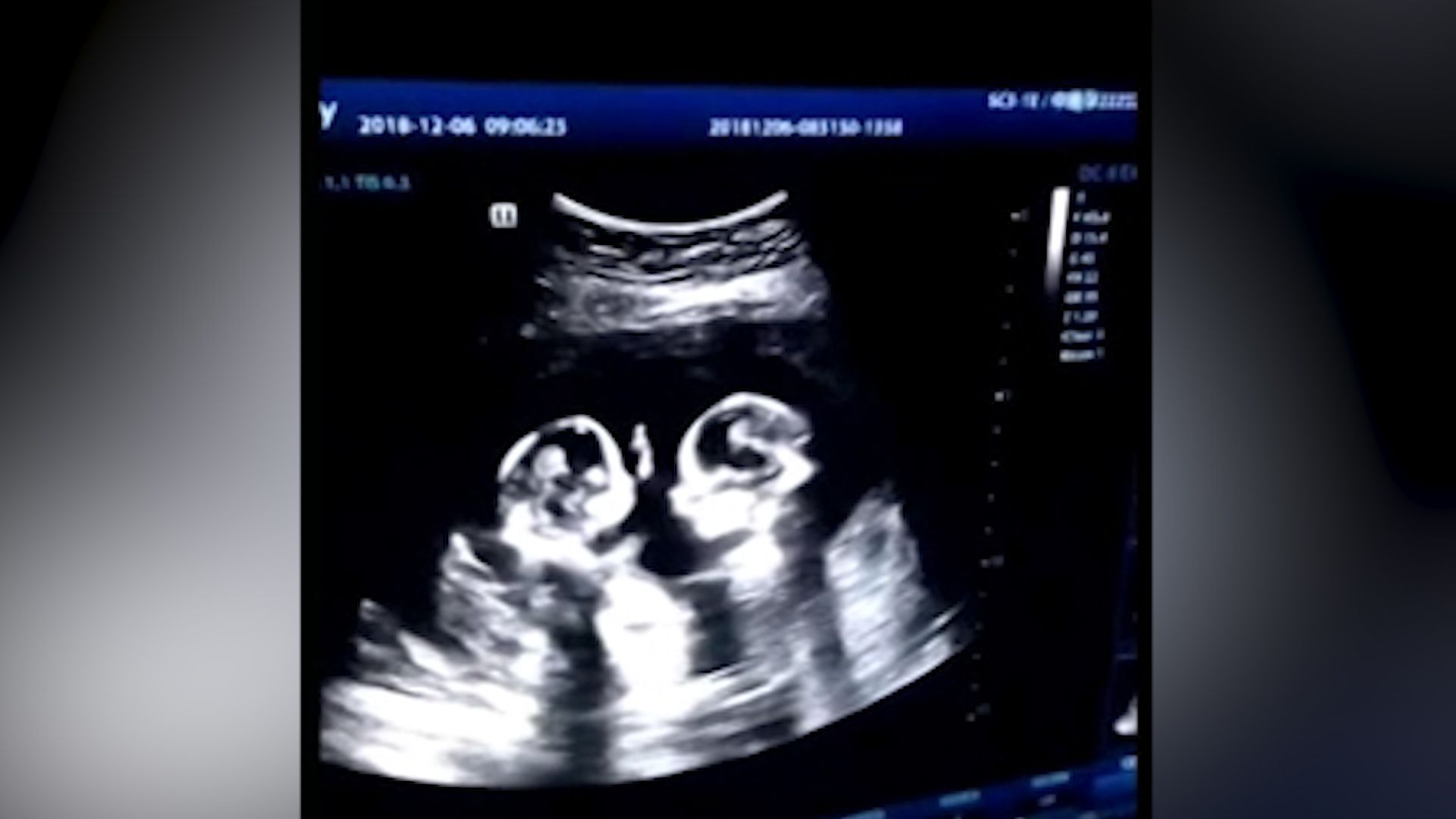 Boj o místo v děloze. “Hovory” dvojčat odhalil ultrazvuk