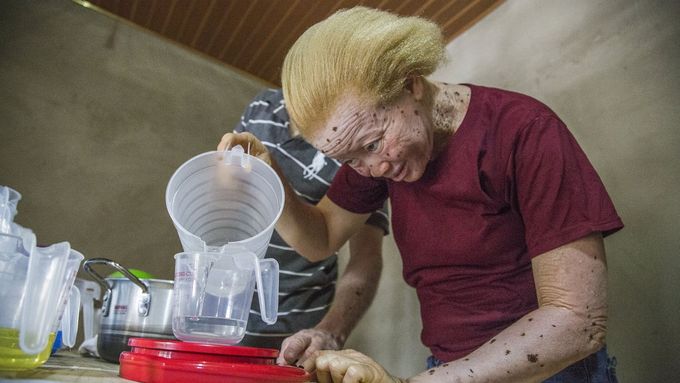Podívejte se, jak si albíni v Ghaně vyrábí opalovací krém díky českým vědcům a dárcům