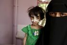 Podvýživa a strach. Pomoc v Jemenu potřebují miliony dětí