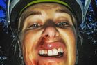Bývalá tenistka Hlaváčková bourala na kole, zuby jí rovnali v nemocnici