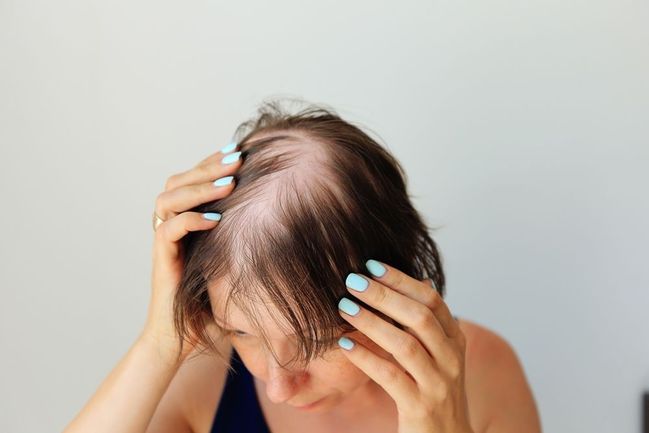 Kolika žen se týká ztráta vlasů? 