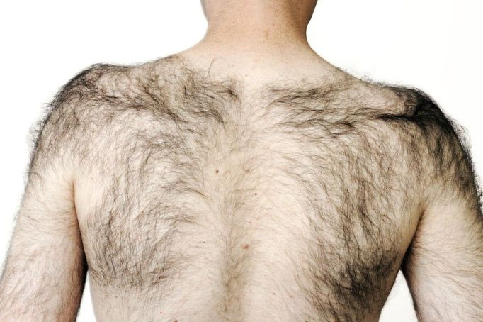 Hirsuitism caused by minoxidil drug MODEL RELEASED. Excessive hairiness (hypertrichosis hirsuitism) in an adult male patient caused by the anti-hypertensive drug minoxidil. Minoxidil, used to treat high blood pressure, has the side-effect of promoting hair growth.