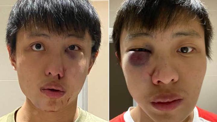 "Nechci tvůj koronavirus." Asiaté čelí fyzickým útokům, ze strachu i odkládají roušky