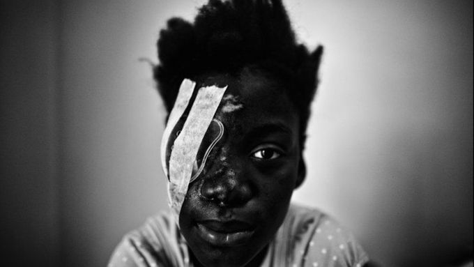 Martin Bandžák: Dívka hospitalizovaná v nemocnici se zraněným okem a tváří při zemětřesení, Port-au-Prince, únor 2010