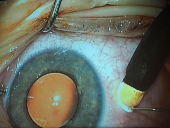 Na snímku je vidět aplikace cytostatik jehlou přímo do sklivce oka a také zmražování vpichu i jehly.