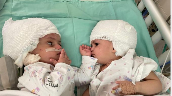 V Izraeli poprvé oddělili siamská dvojčata srostlá hlavami