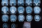 Čeští lékaři mají nový nástroj na odhalení Alzheimerovy nemoci