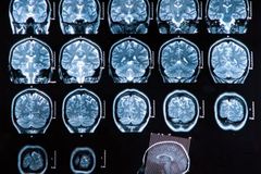 Naděje v léčbě Alzheimera? Mladík vyvinul unikátní test