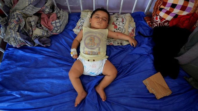 Palestinské dítě trpící těžkou podvýživou na dětském oddělení nemocnice Al-Aksá Martyrs Hospital v Gaze. Kojenecká výživa tu už téměř došla.