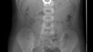 Skutečné anonymizované rentgenové snímky pacientů Kliniky dětské
chirurgie FN Brno po spolknutí magnetických kuliček.