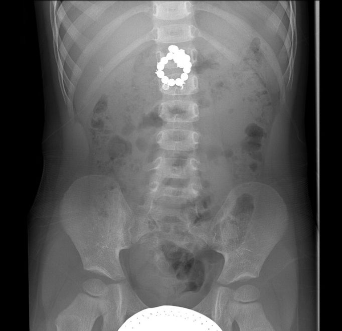 Skutečné anonymizované rentgenové snímky pacientů Kliniky dětské
chirurgie FN Brno po spolknutí magnetických kuliček.
