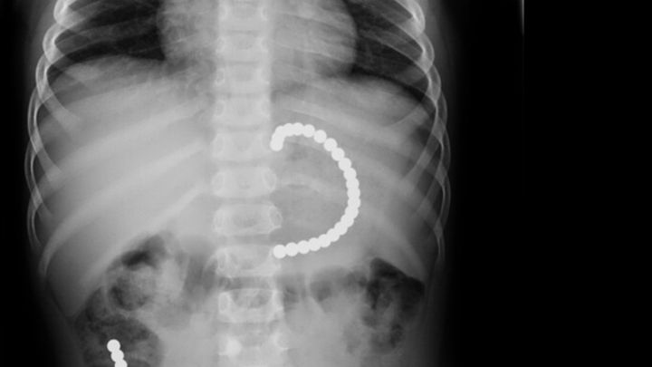 Nekupujte dětem magnetické kuličky, varuje inspekce. Při polknutí se v těle pospojují; Zdroj foto: ČOI