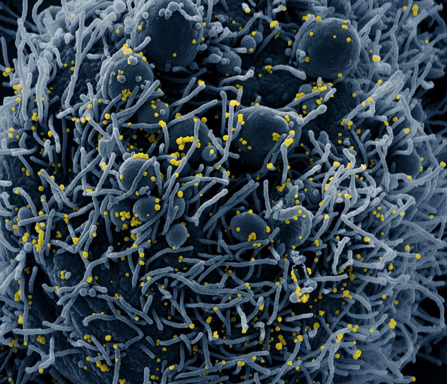 Fotografie koronaviru napadajícího buňky na snímcích z elektronkového mikroskopu, pořízené americkým Národním institutem pro alergie a infekční nemoci NIAID