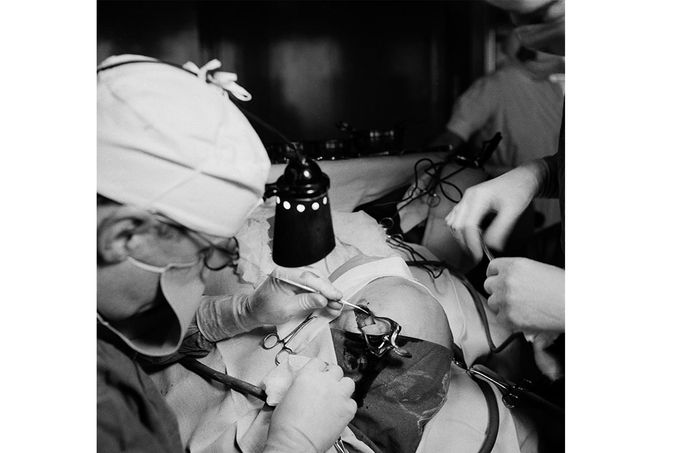 Lékaři provádějí lobotomii na Södersjukhuset ve Stockholmu, Švédsko, 1949. Foto: Lennart Nilsson