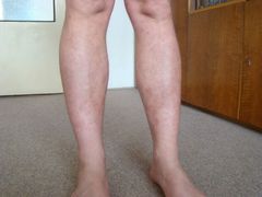 Nohy pacienta po deseti týdnech léčby novým přípravkem