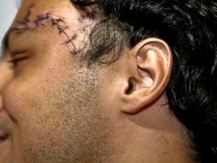 Tvář Felipe Massy "zdobí" velká jizva.