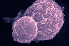 Objev: Každou šestou rakovinu spouští zbytečná infekce