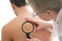 Nová metoda: Riziko rakoviny kůže odhalí počet mateřských znamének na pravé ruce