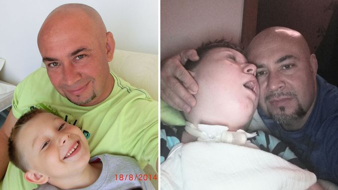 Osmiletý Adámek před a po operaci.