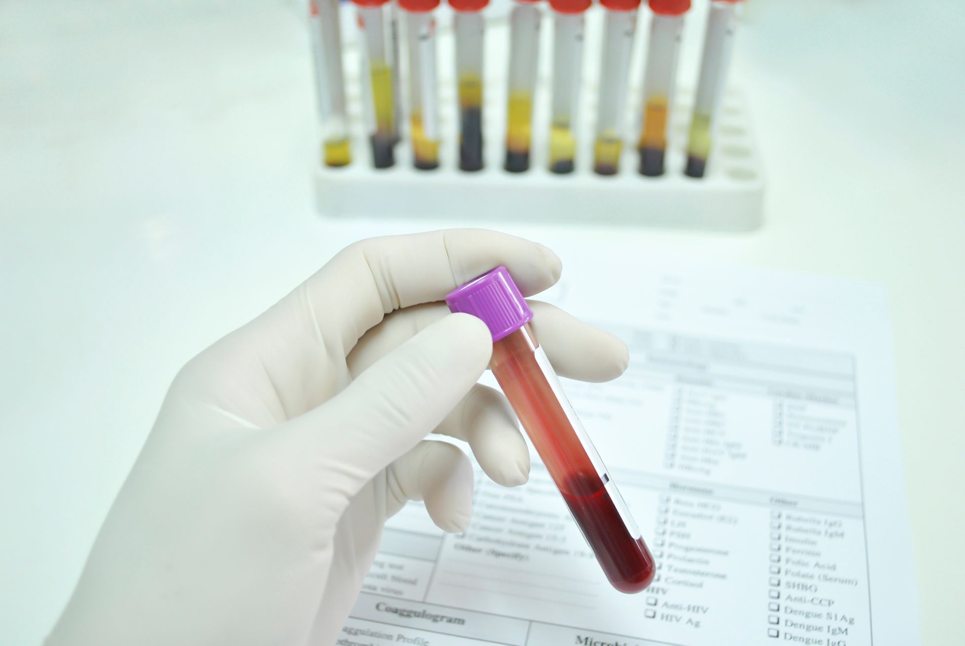 Клиническая лаборатория общий анализ. Исследование крови. Пробирки исследования. Лабораторные исследования крови. Клиническая пробирка крови.