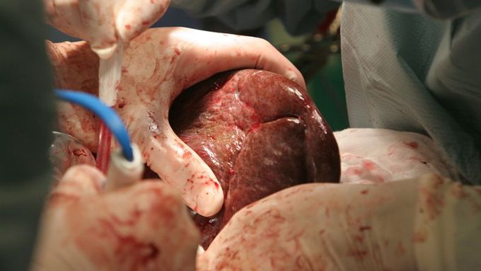 Unikátní fotogalerie: Takhle se transplantují játra