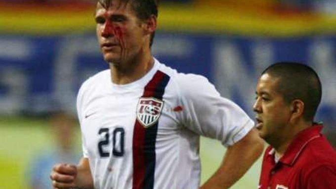 Americký útočník Brian McBride zraněný při utkání s Itálií.