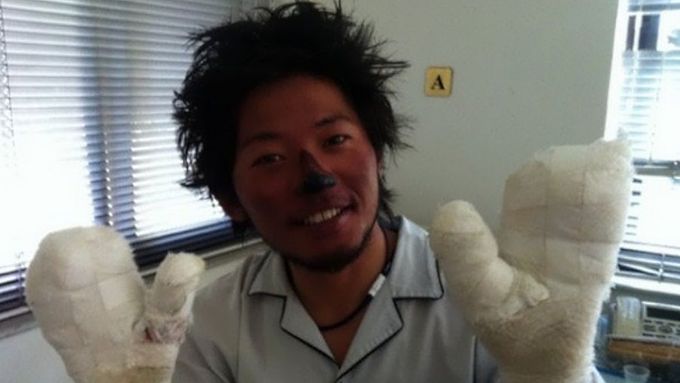 Japonský horolezec Nobukazu Kuriki při svých dřívějších lezeckých pokusech přišel kvůli omrzlinám o devět konečků prstů.